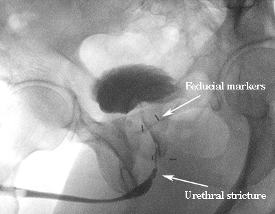 urethral stricture xray image
