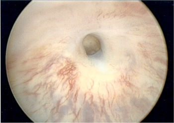 Urethral stricture as seen a cystoscope
