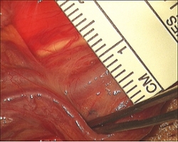 Swollen vein in the spermatic cord