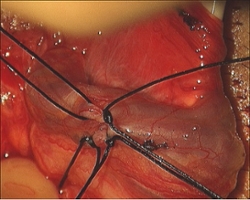 Ligated venous branches of the spermatic cord