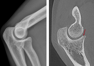X-Rays of Elbow Comparing Traditional and 3D Augmented Scans