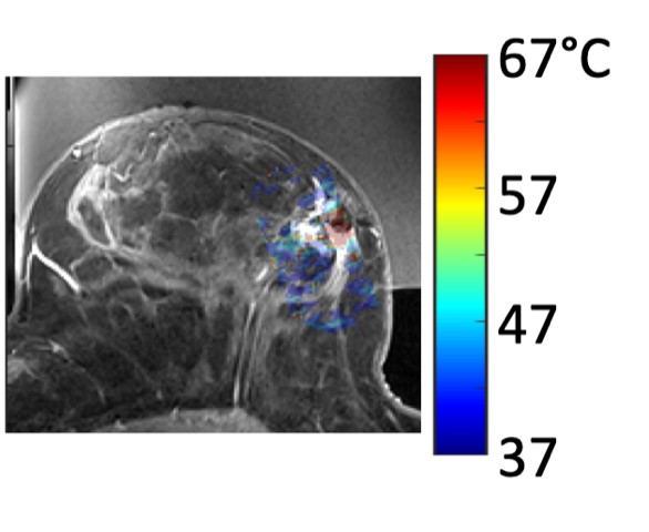 Contrast enhanced T1-weighted image of the breast with the temperature map overlaid.