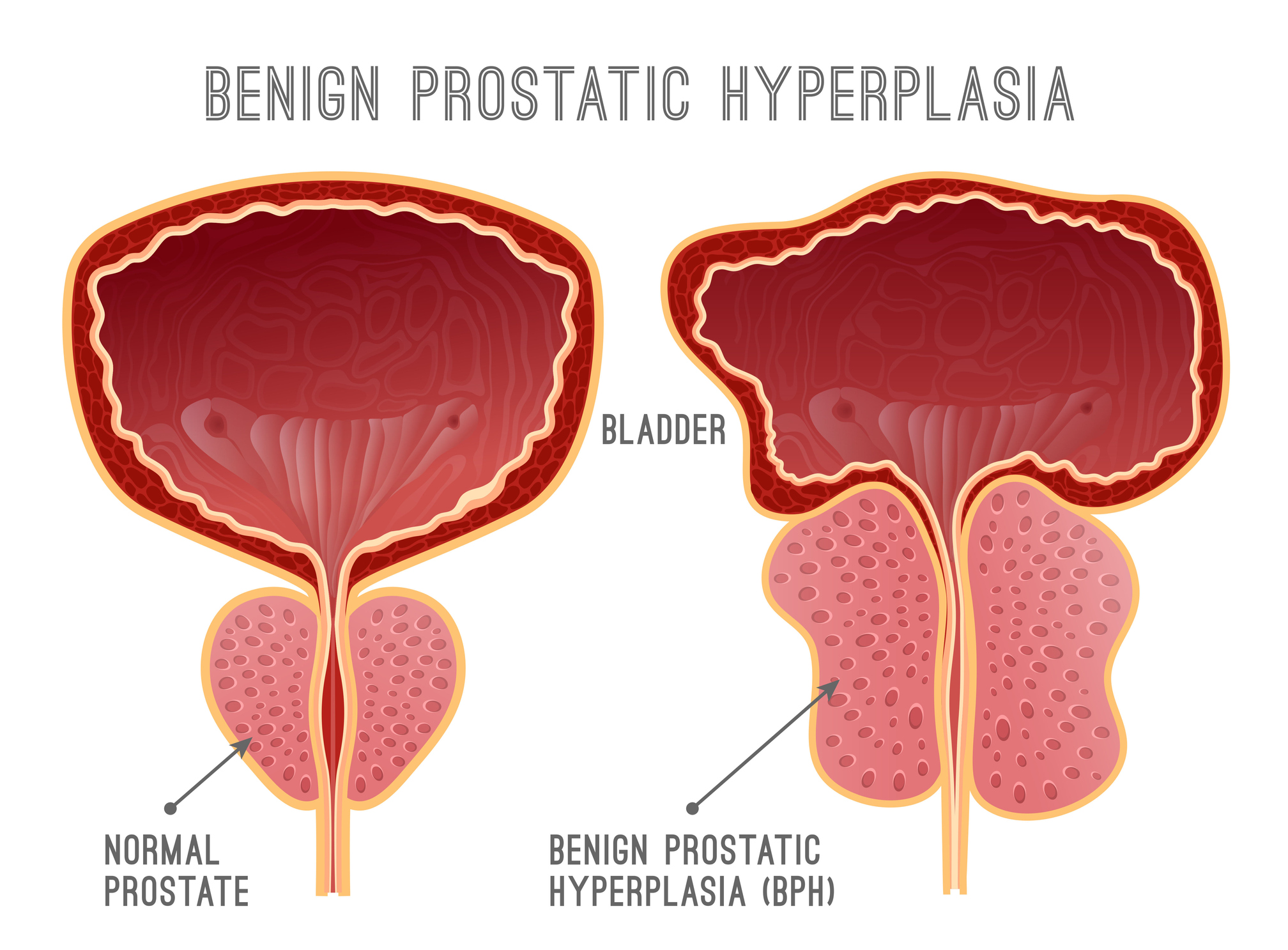 Benign Prostatic Hyperplasia