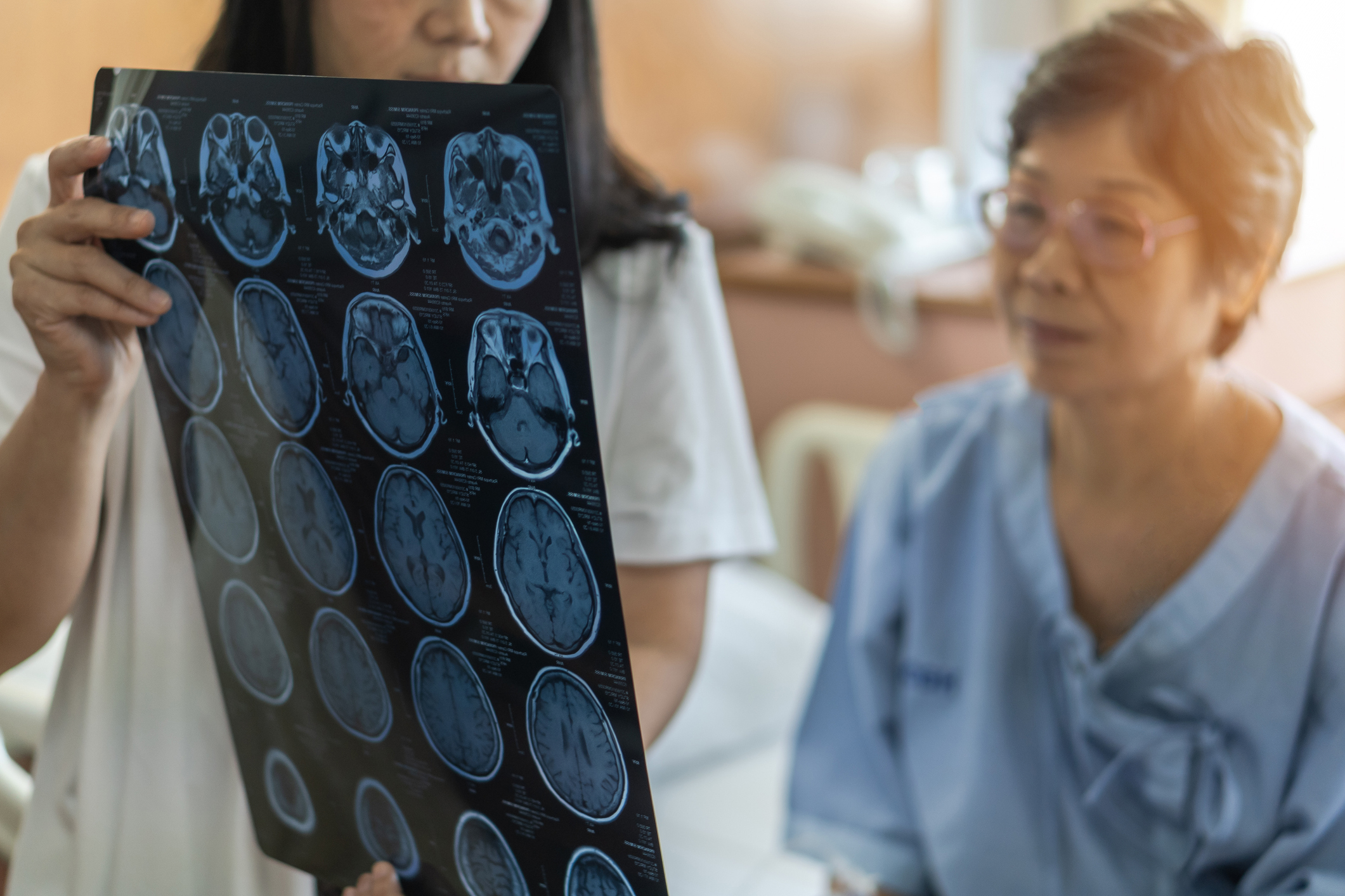 Why Women Are More Likely to Suffer a Stroke
