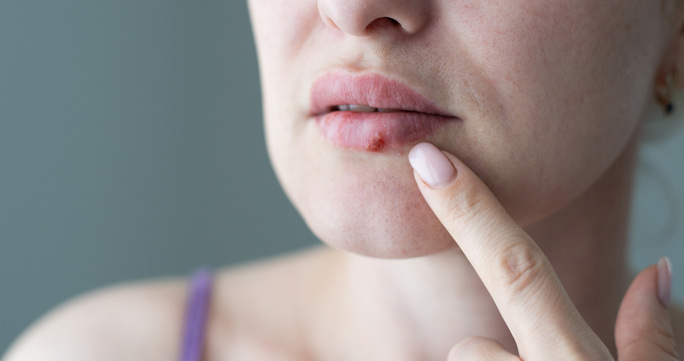 Cold Sores: Causes, Treatments, and Prevention