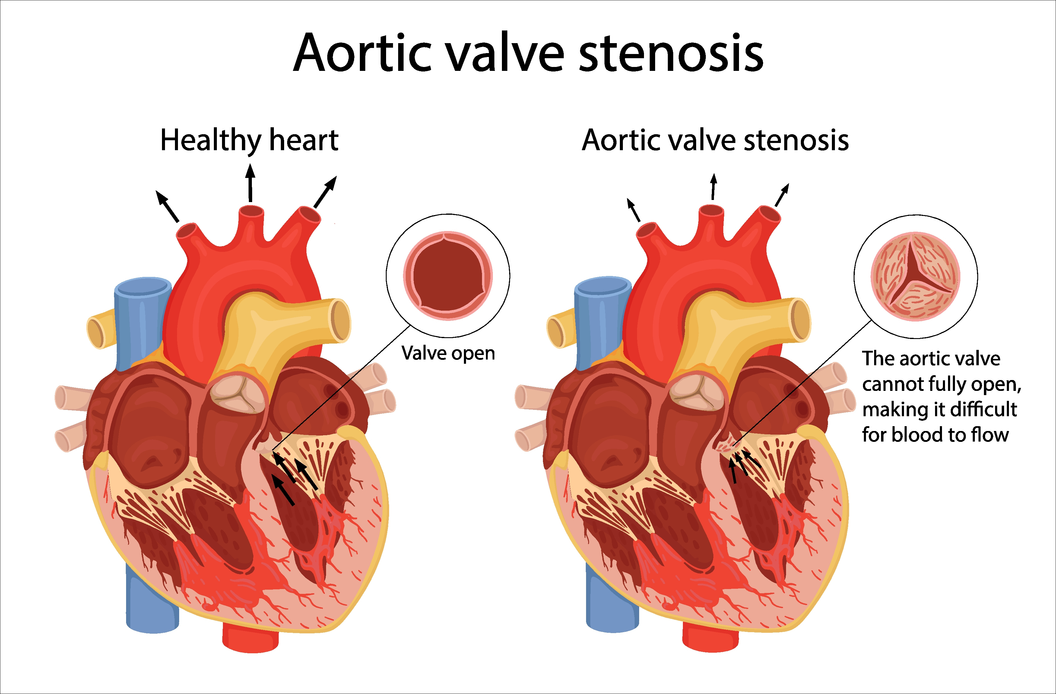 Aortic stenosis