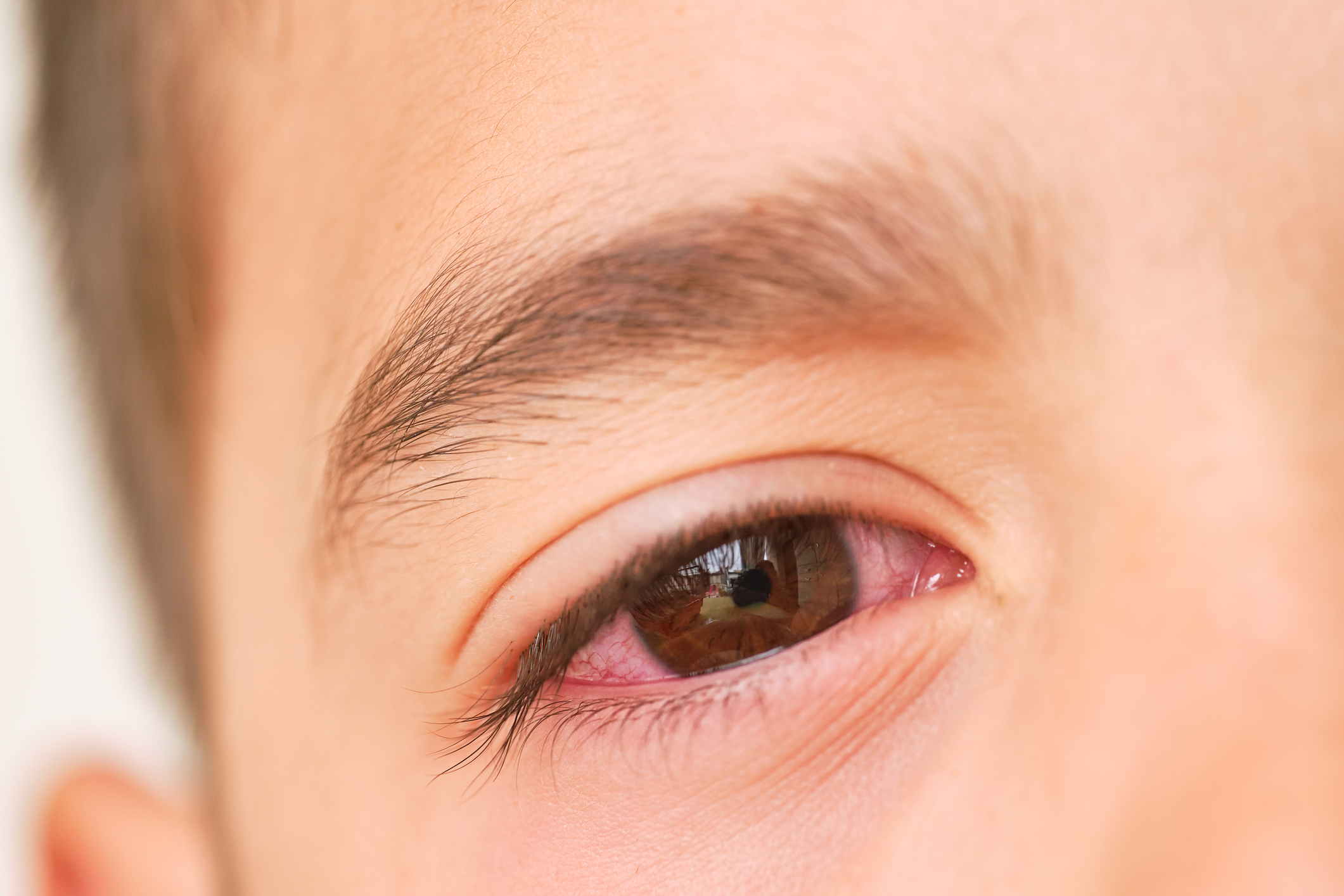 Three Types of Pink Eye and How to Prevent it