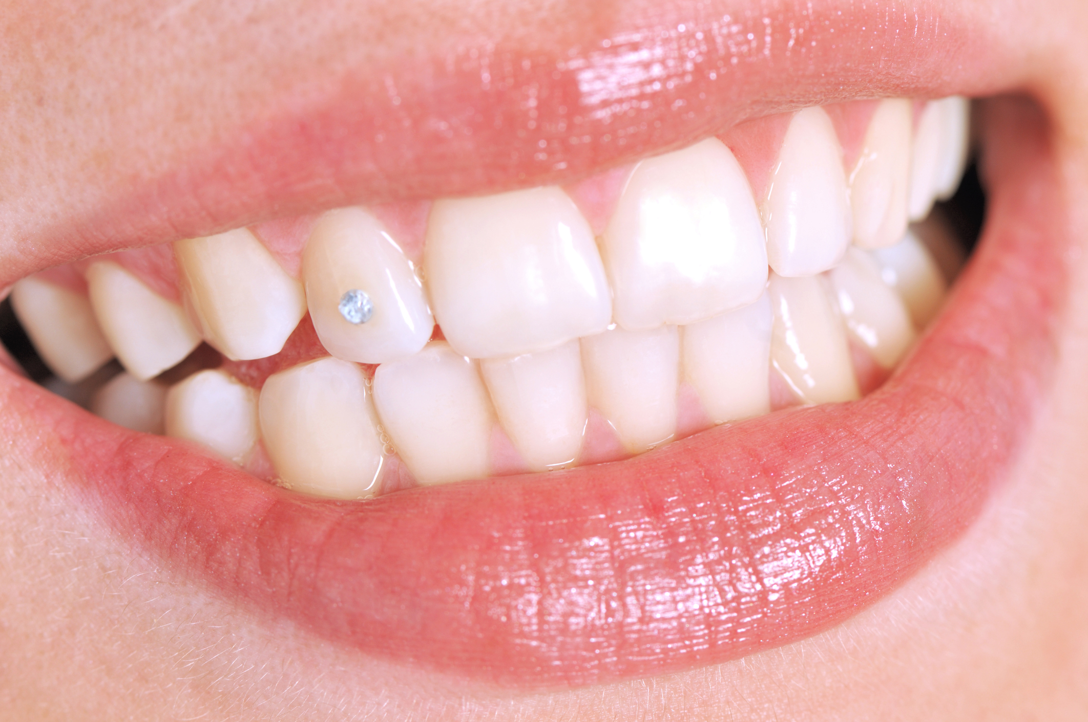 Tooth Gems: Are They Safe for Your Teeth?