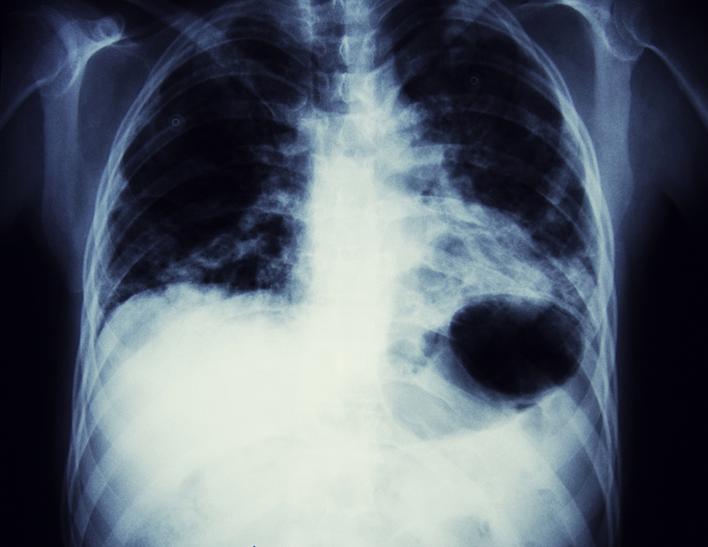 Understanding Updated Guidelines for Lung Cancer Screening