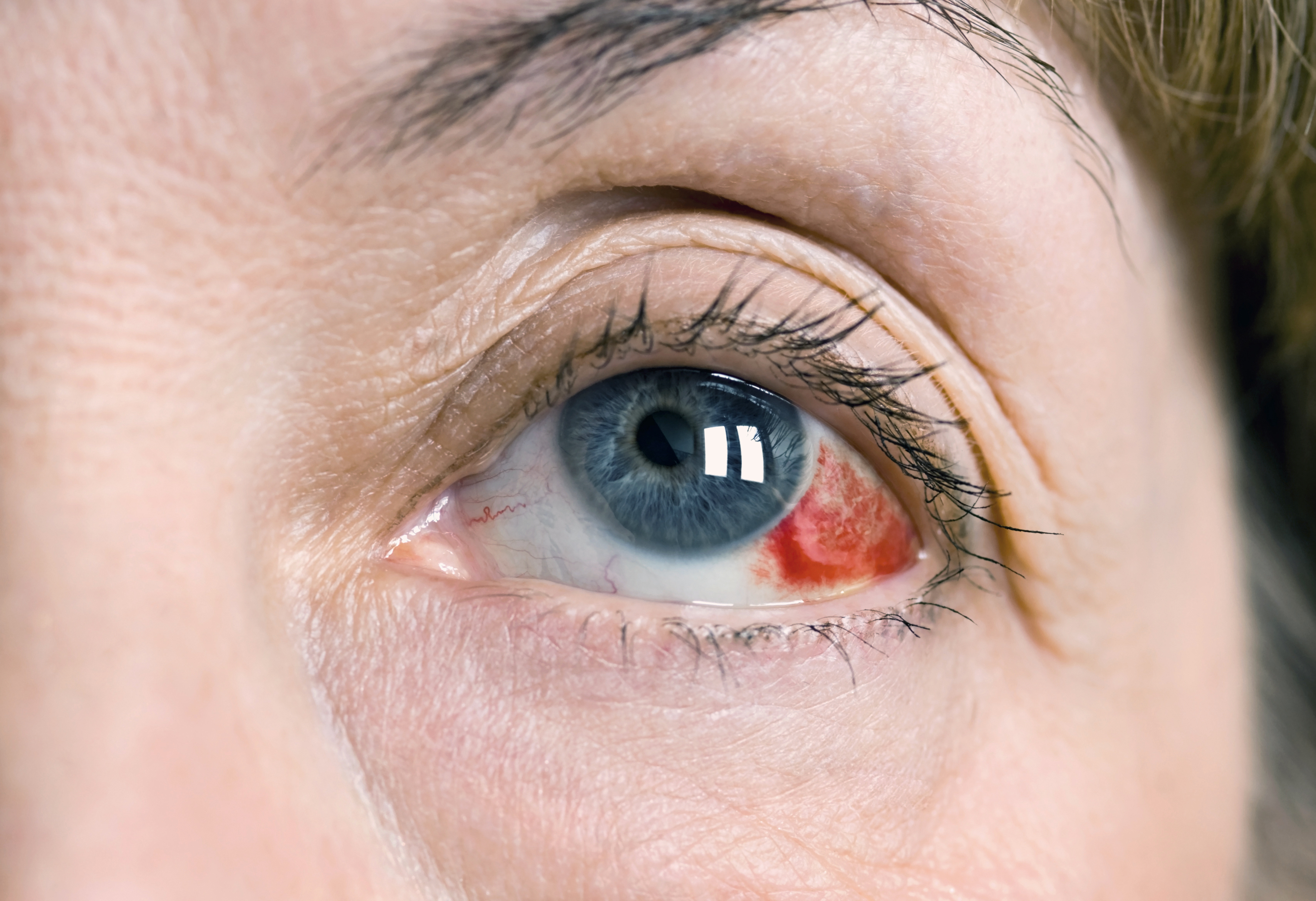 ER or Not: Broken Blood Vessel in Eye