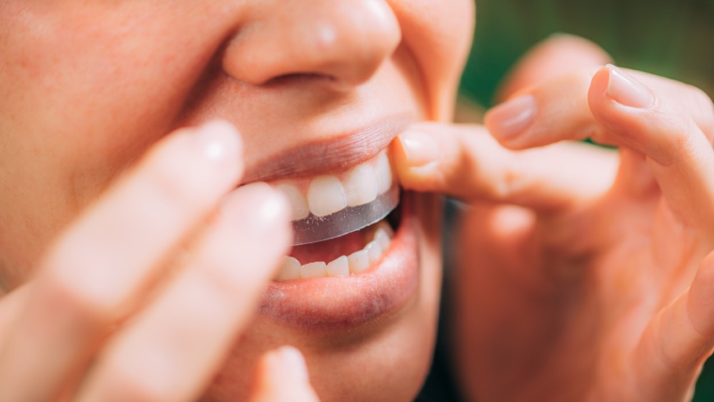 Does At-Home Teeth Whitening Really Work?