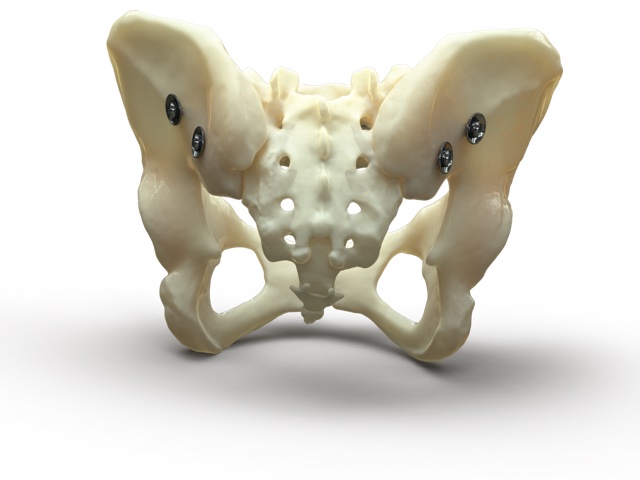 Demonstration of the Bone Bolt System being used to repair a posterior pelvic fracture.