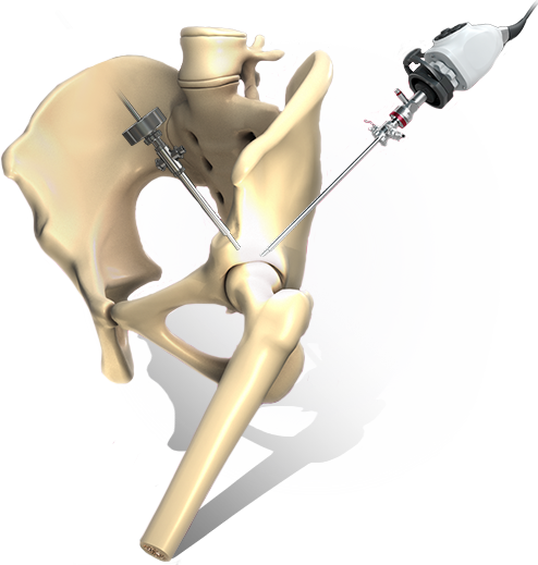 hip surgery illustration
