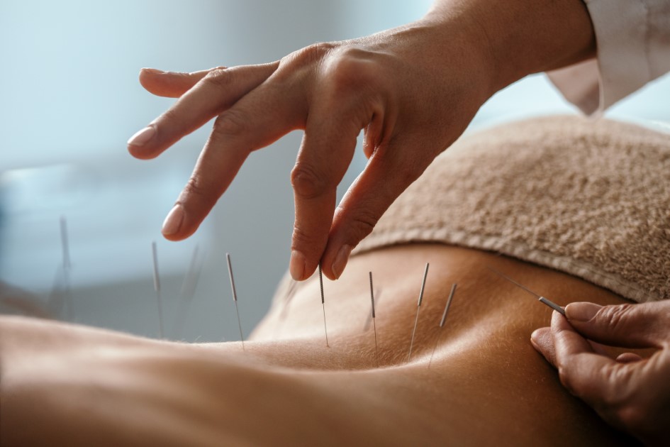 Holistic Hot Flush Relief: Acupuncture and MENOGAP Explained