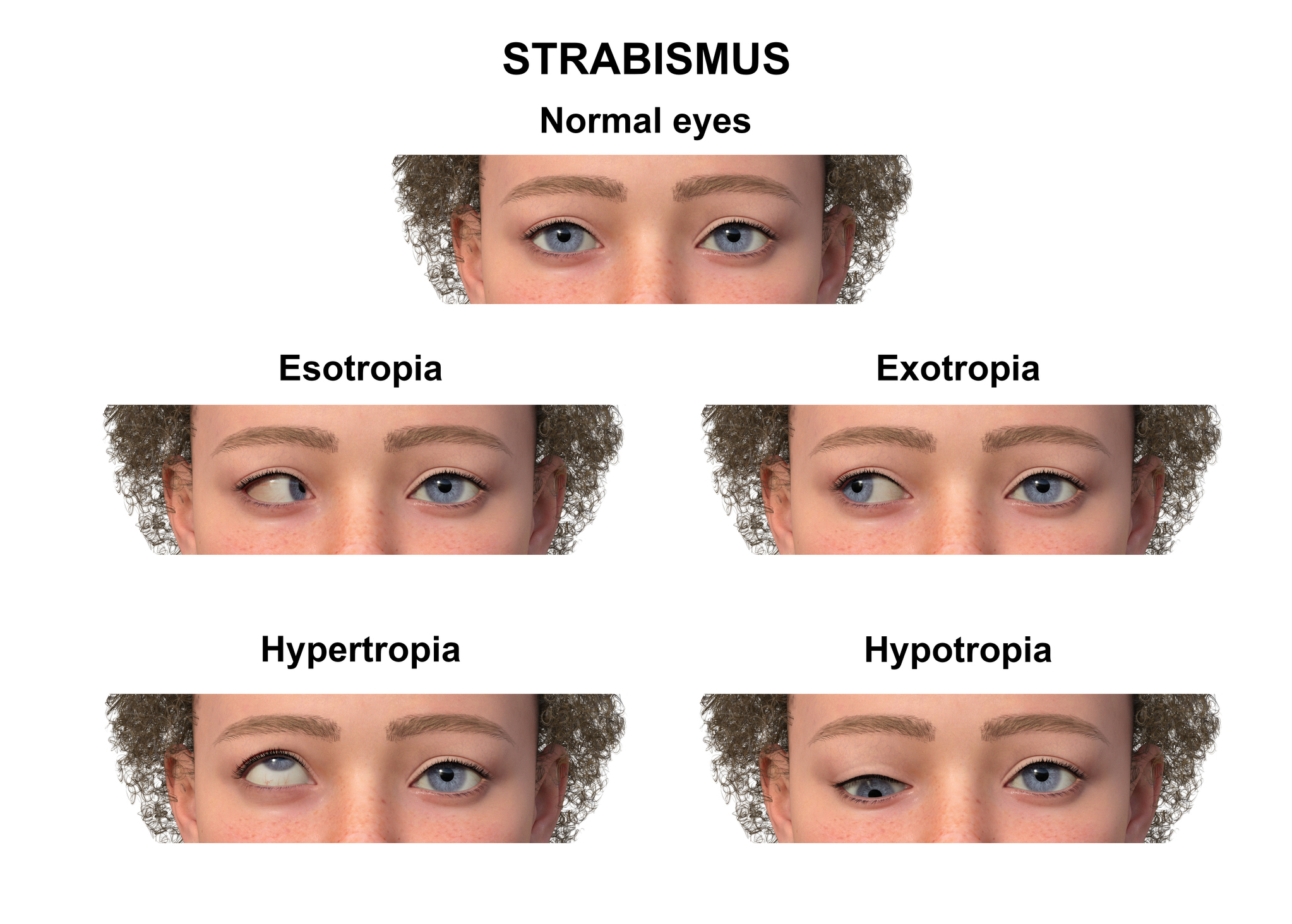 straibusmus types