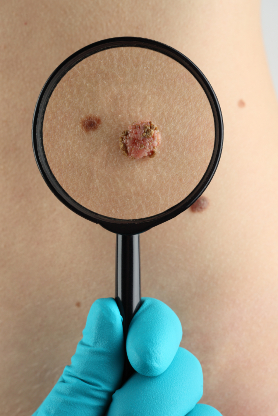 Mapping Moles Is an Effective Way to Fight Skin Cancer
