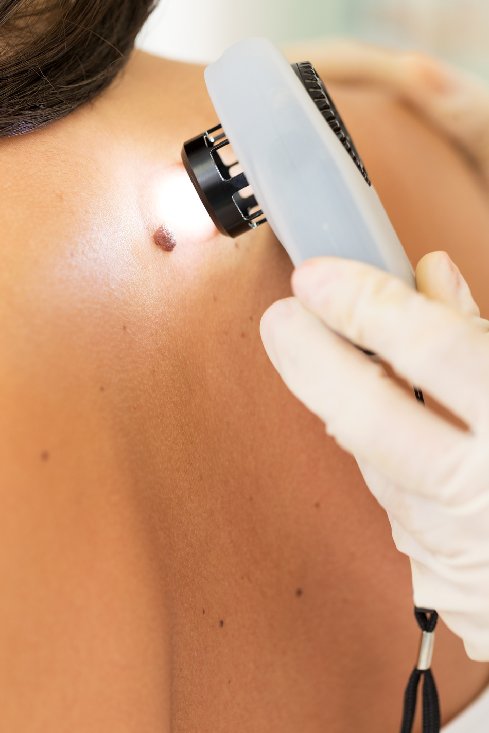 How Dangerous is Skin Cancer, Really?