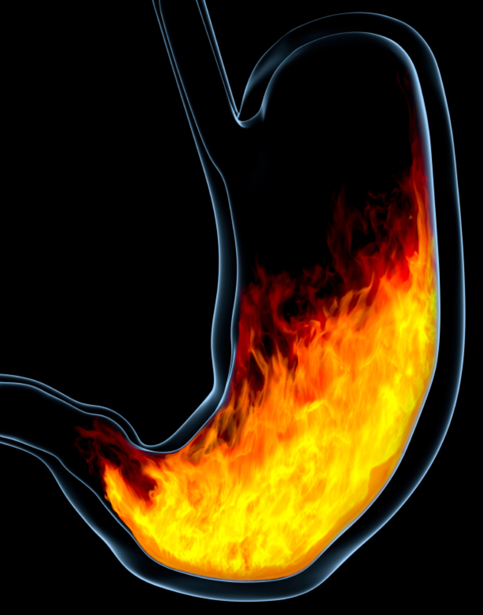 Frequent Heartburn? You May Want to Visit Your Doctor