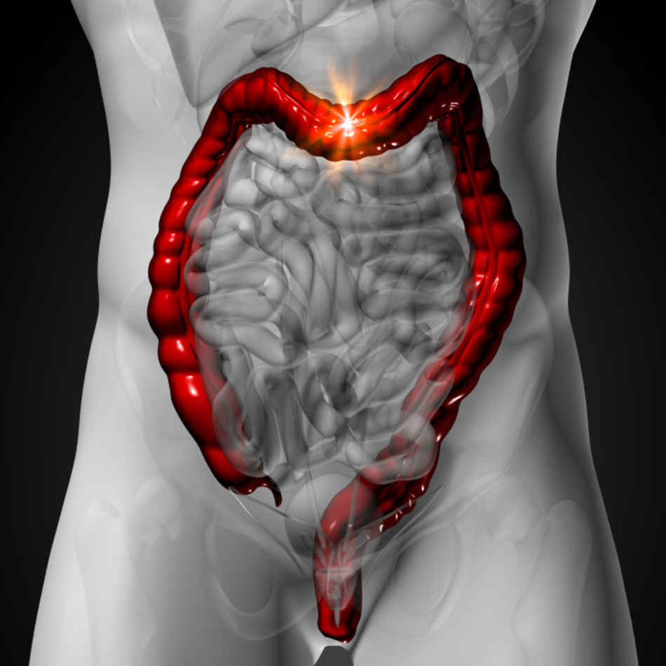 A Potential Source of Your Abdominal Pain: Diverticulitis