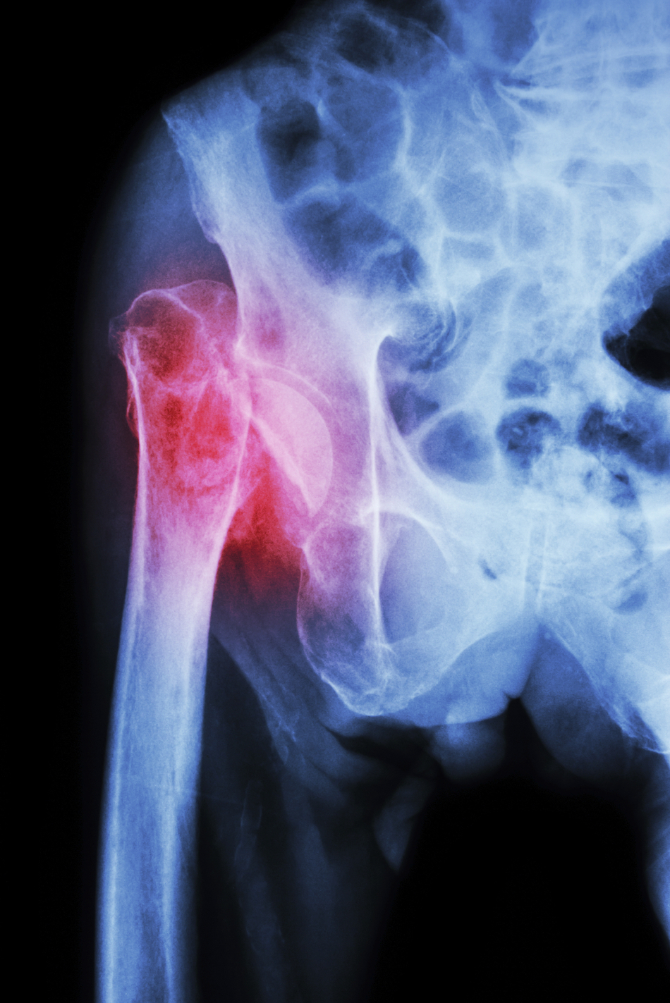 You Can’t Cast It: Pelvic Fracture Treatment