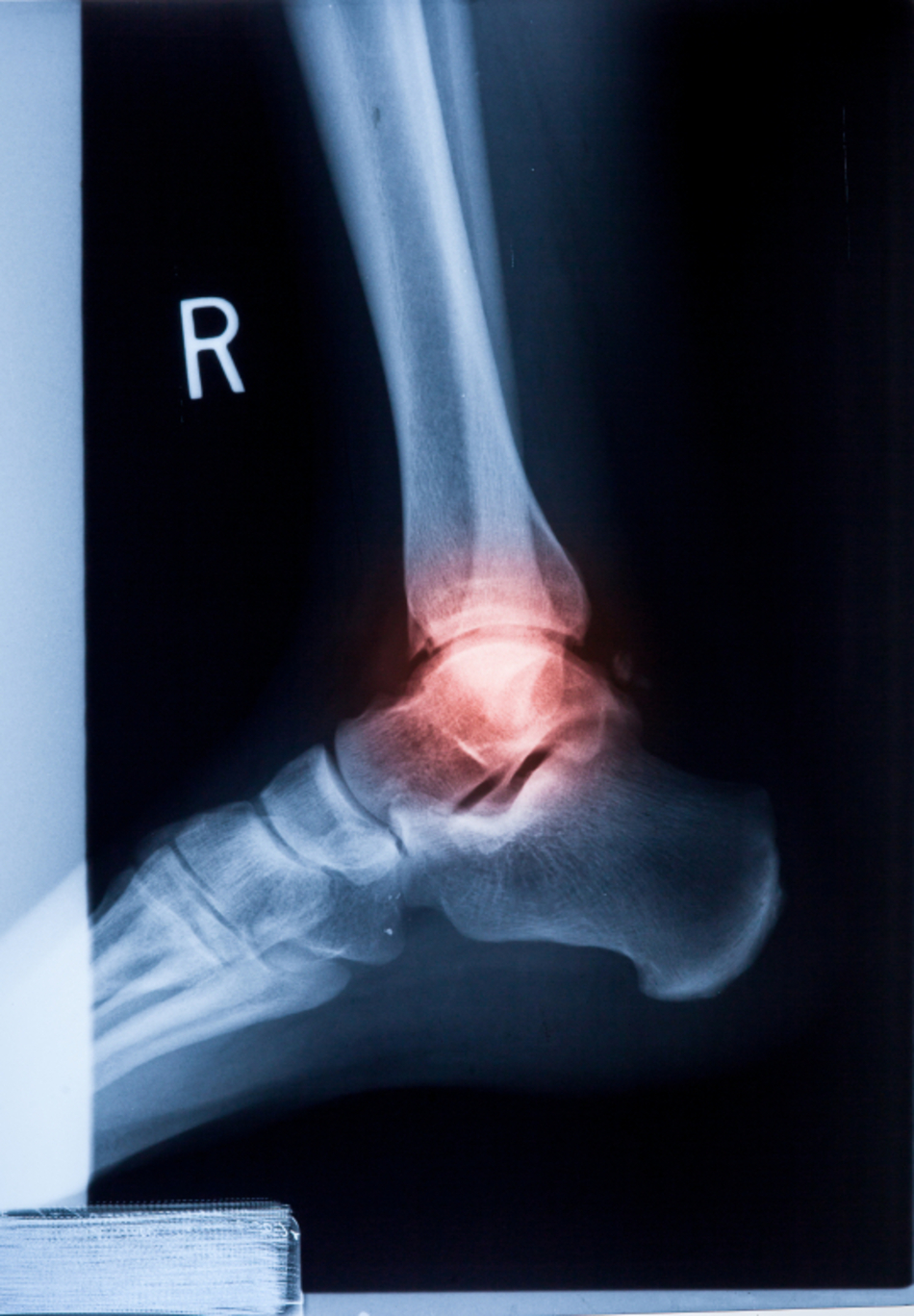 My Ankle is Sprained—But is it Fractured, Too?