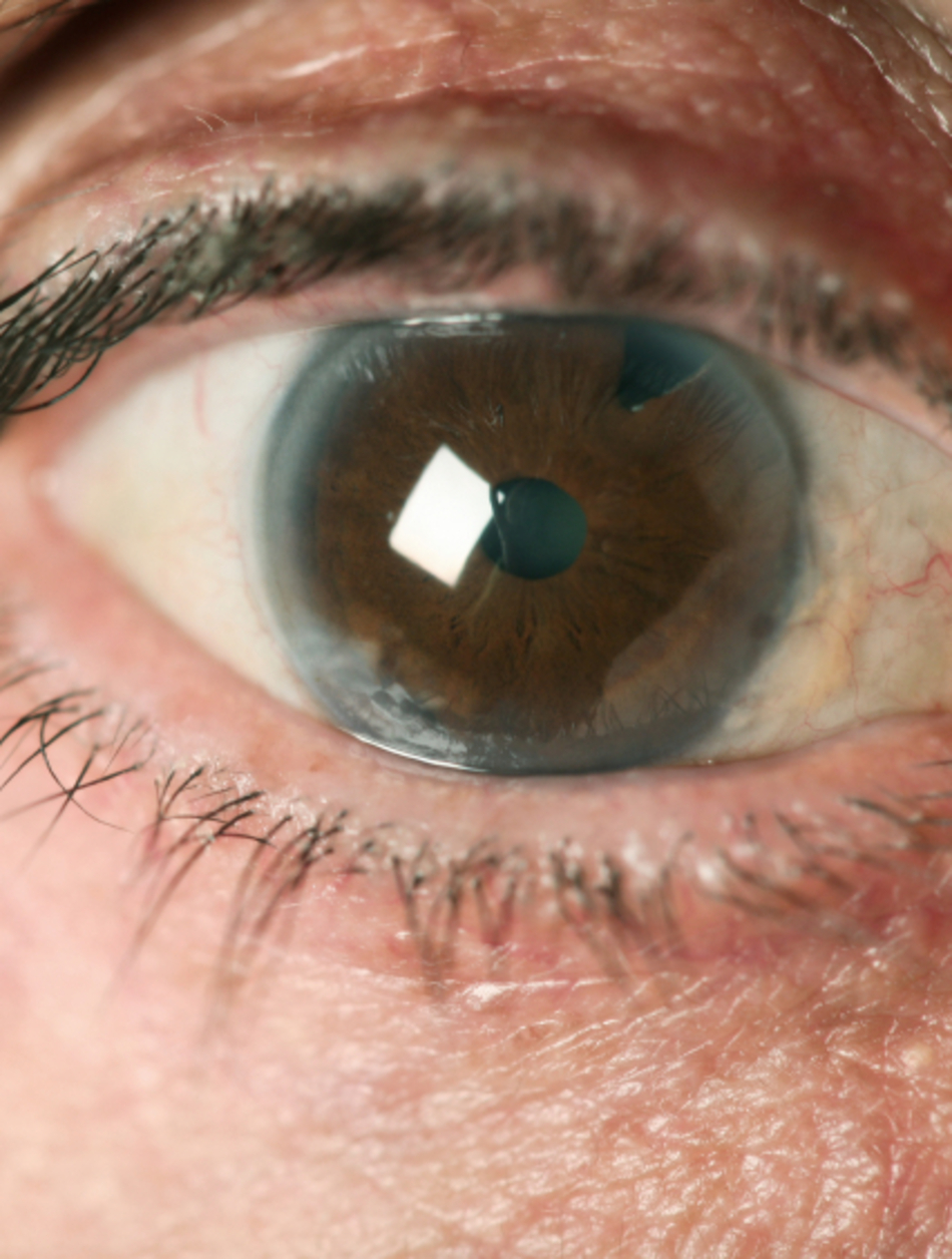 The Facts on Cataracts
