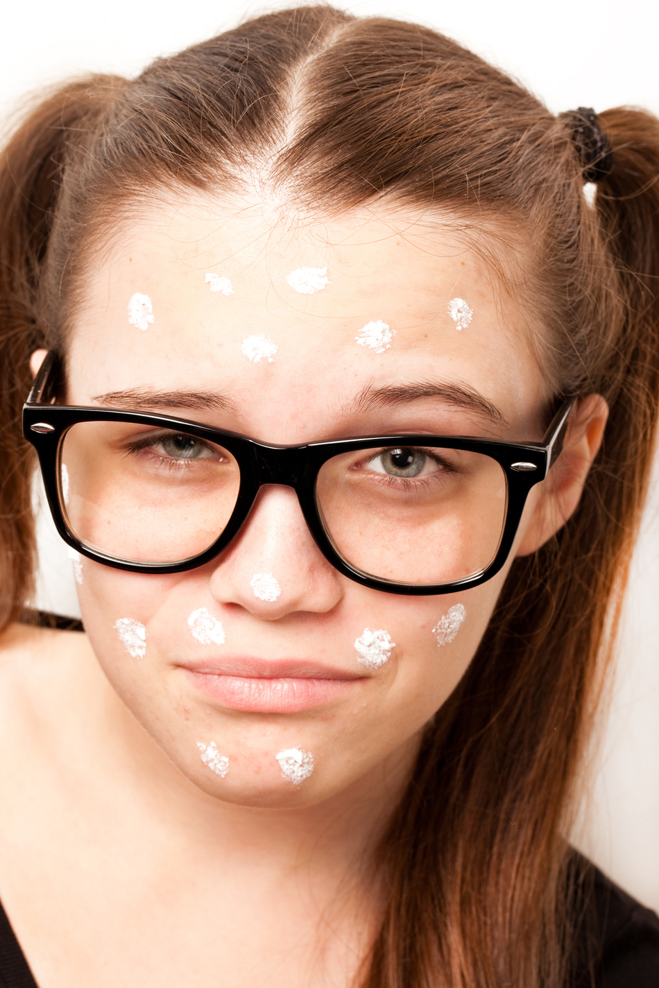 Acne: Embarrassing But Treatable