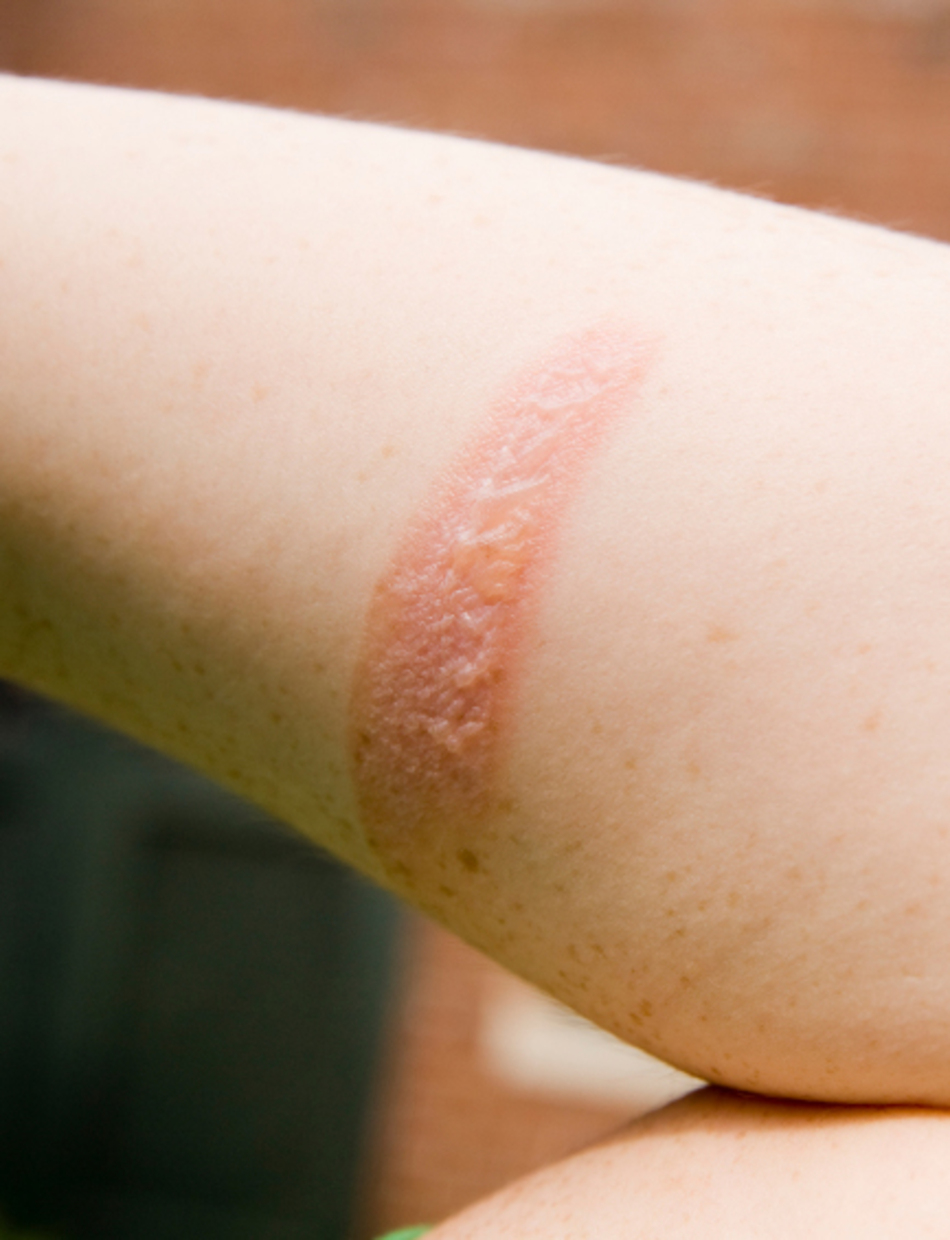 Heating Pads Can Cause Second-Degree Burns