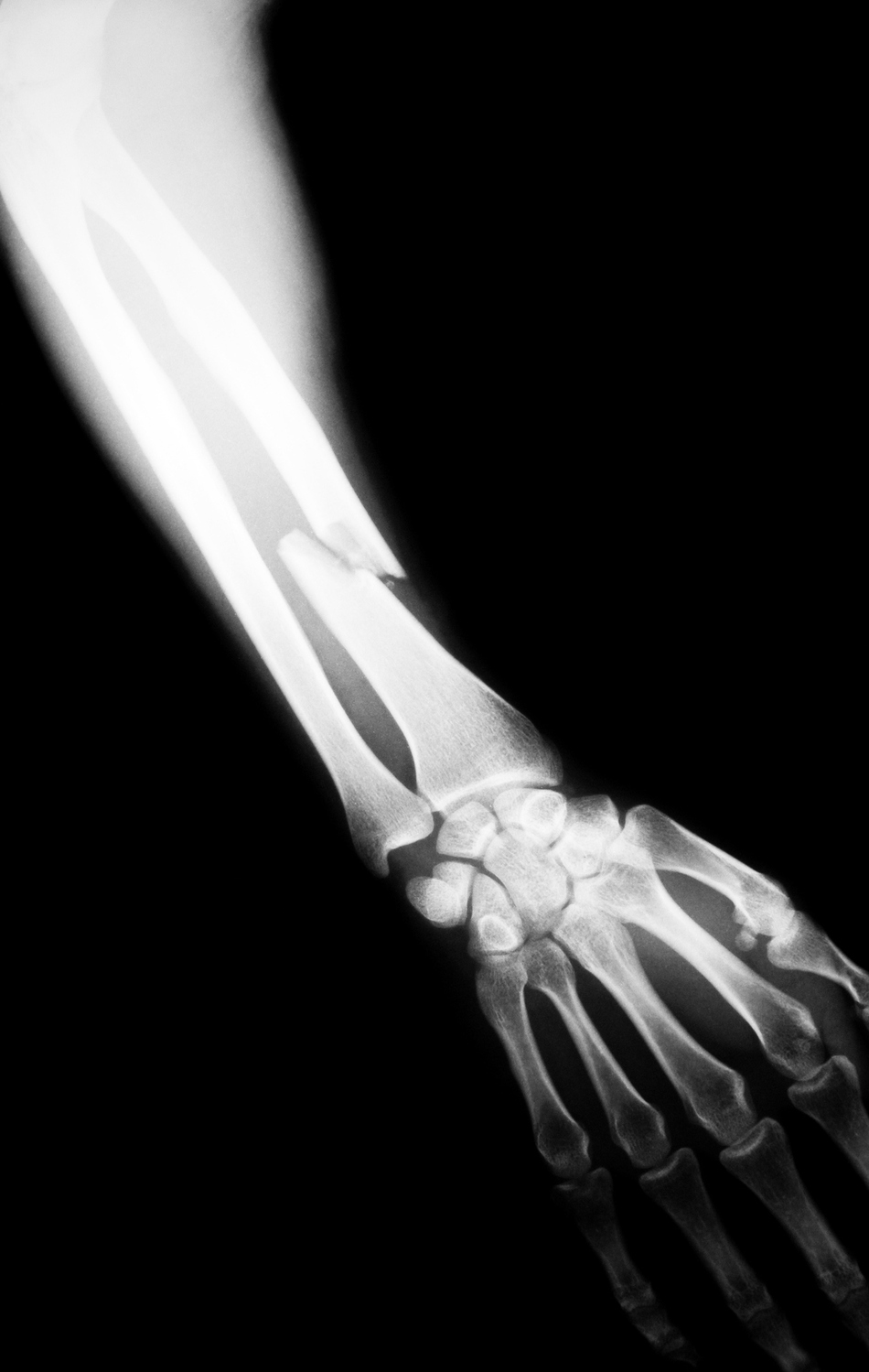 Listener Question: What Should I Do About Bone Fractures?