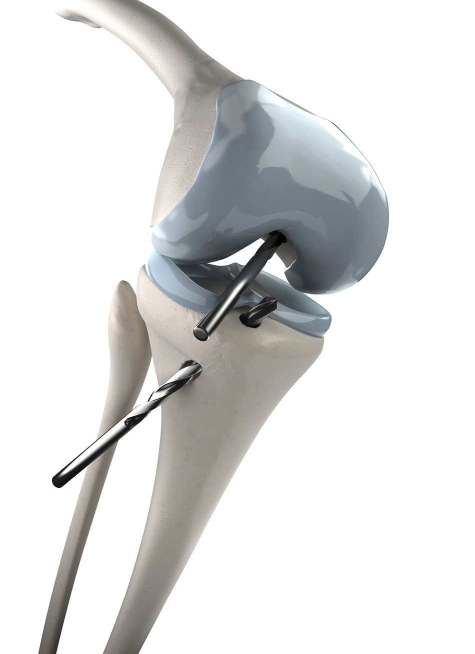 Should You Have Your Knee Scoped After an Injury?
