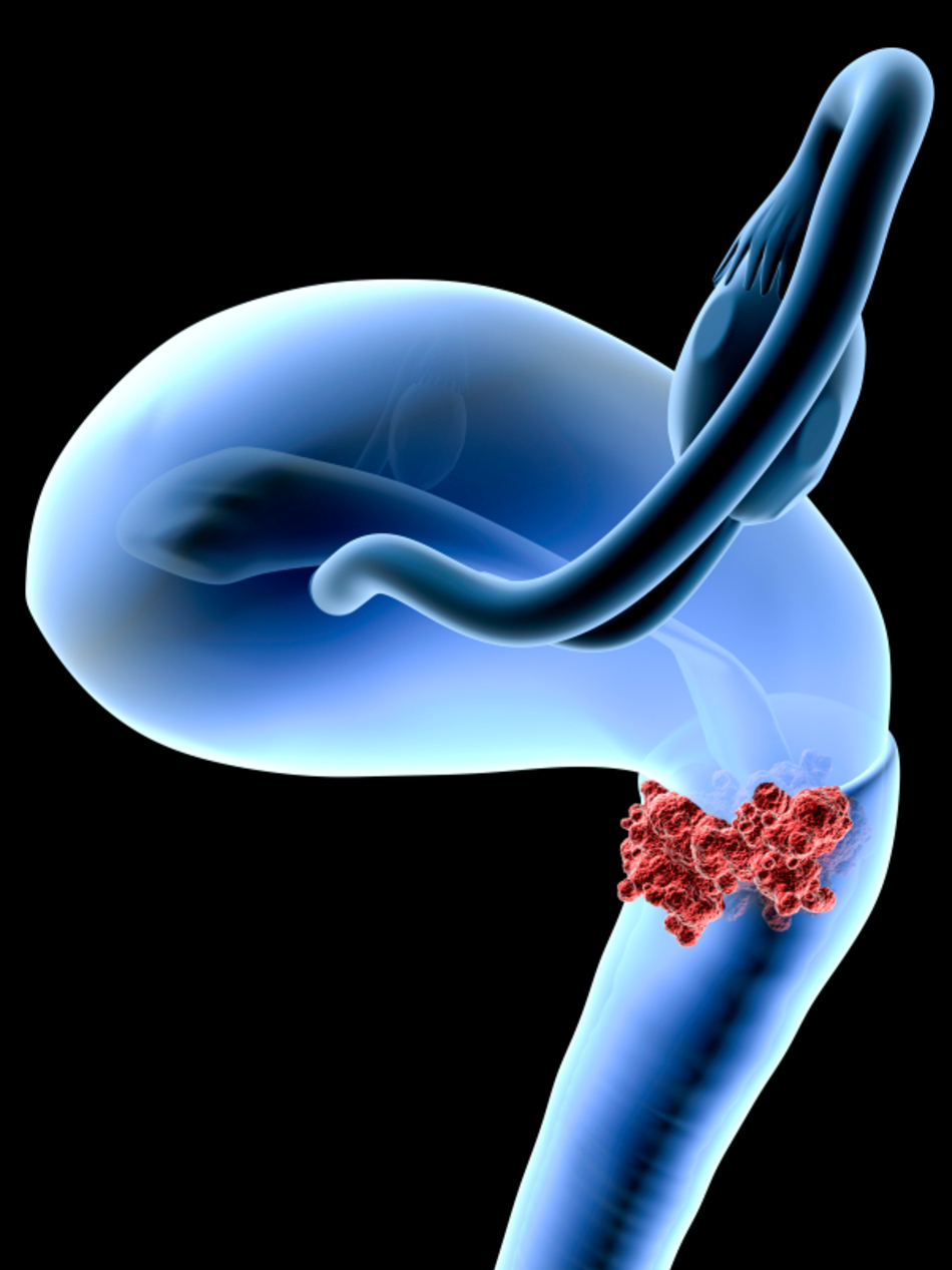 Eliminate Your Chances of Getting Cervical Cancer