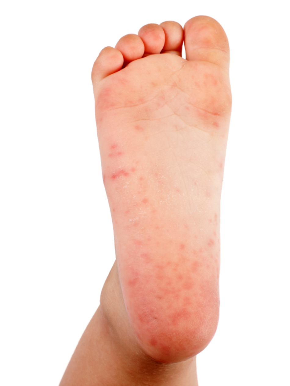 It’s Not Strep Throat: Treating Hand, Foot, and Mouth Disease