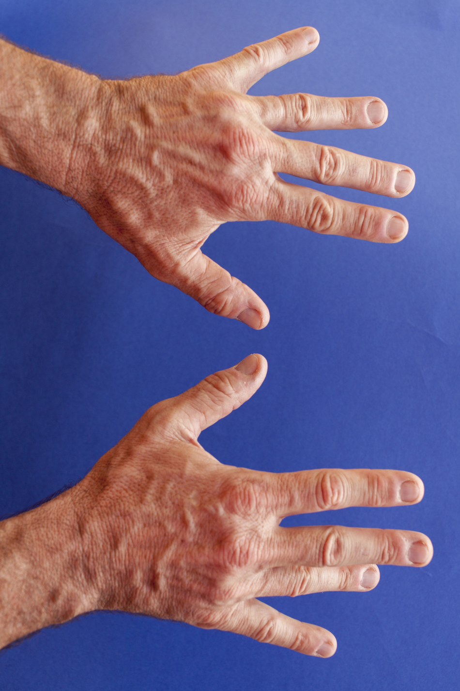 Treating Dupuytrens Contracture