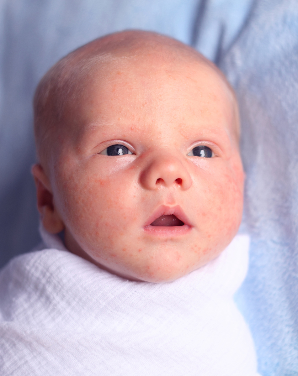 What Does it Mean if My Newborn Has Acne?