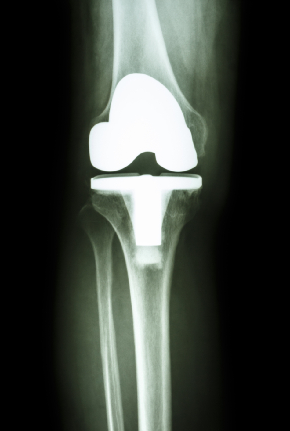 Preparing for a Knee or Hip Replacement Procedure