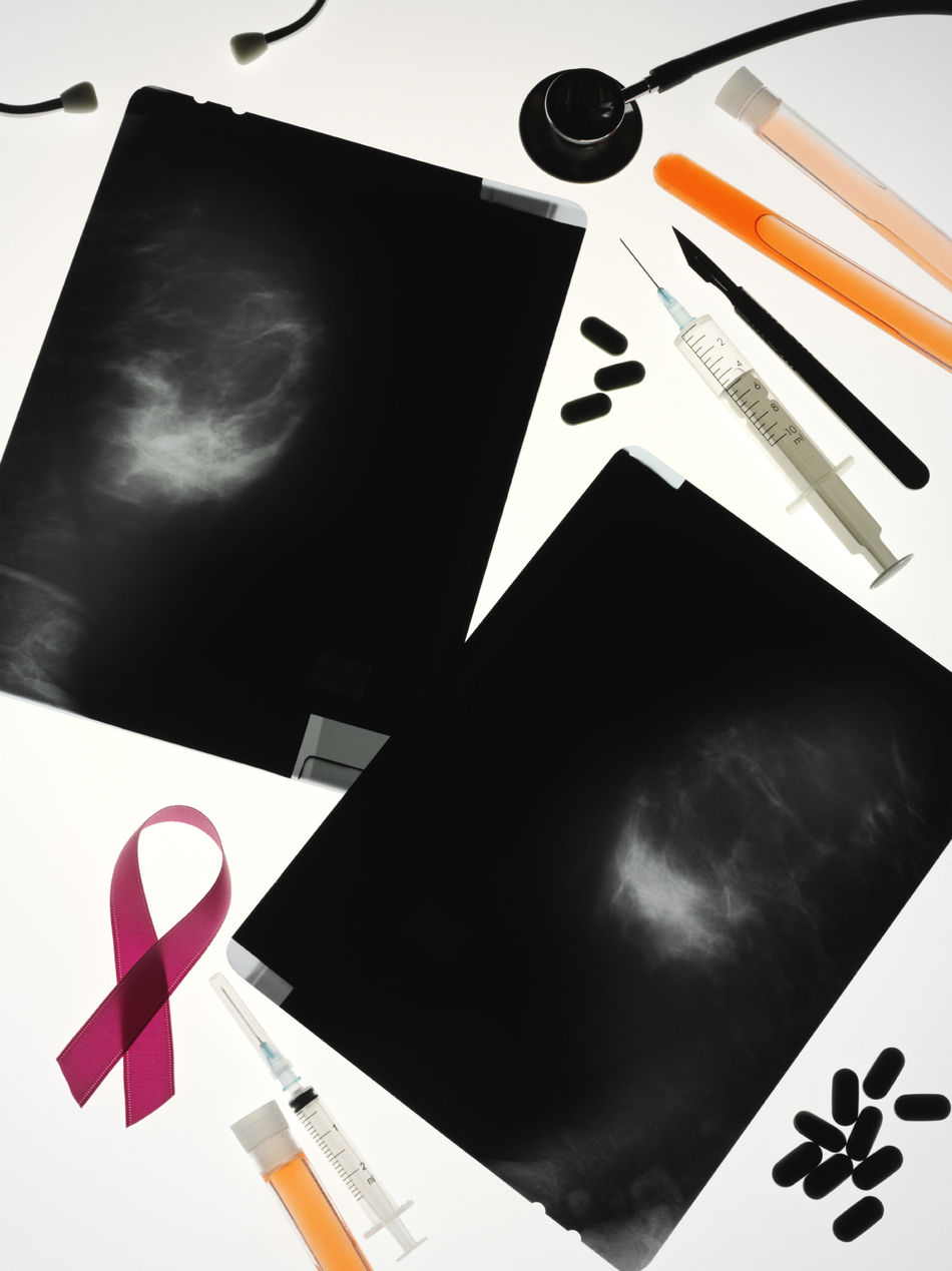 My Mammogram Results Say I Have Dense Breast Tissue – Am I Normal?