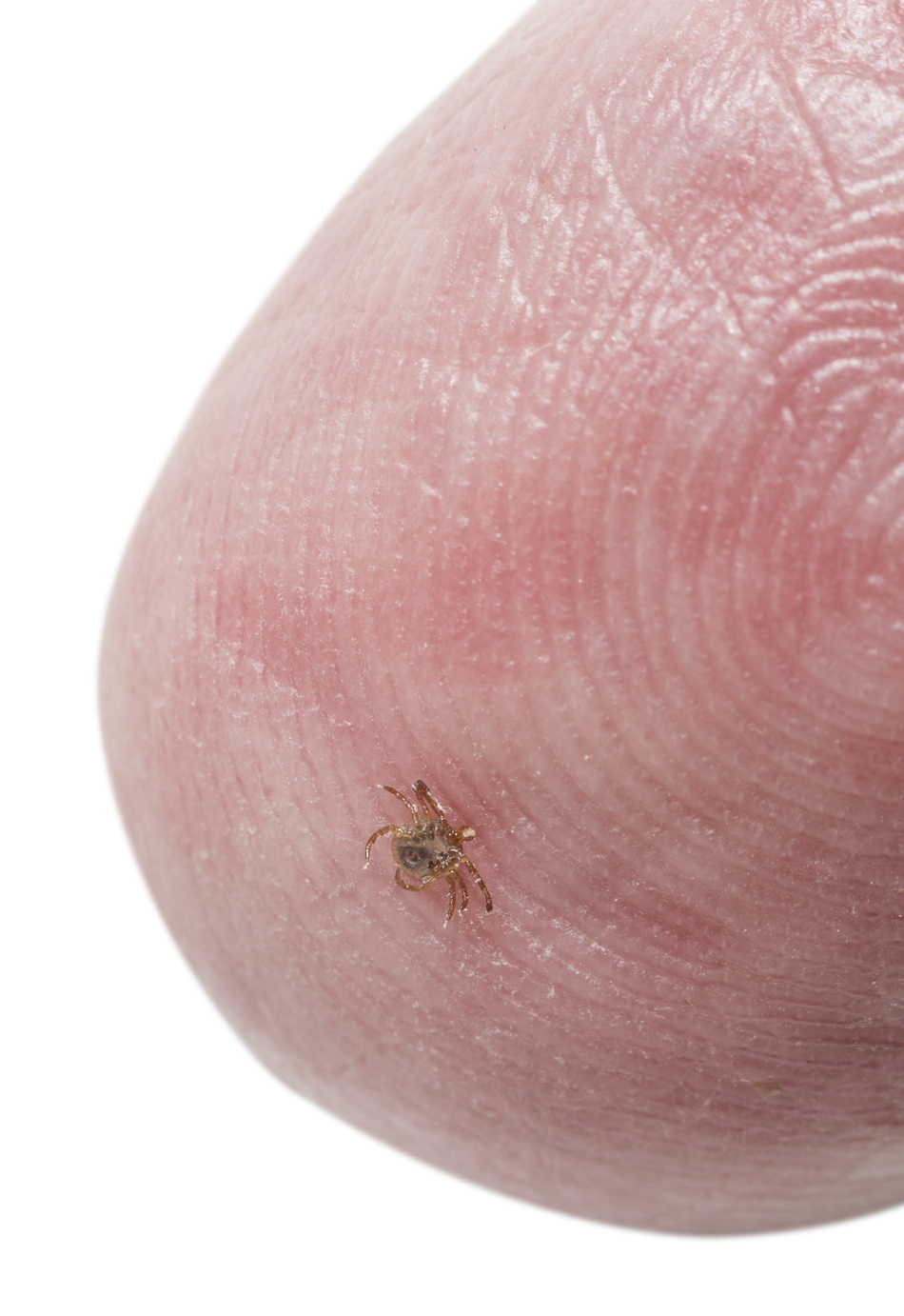 Do I Need to Go to the ER to Remove a Tick?