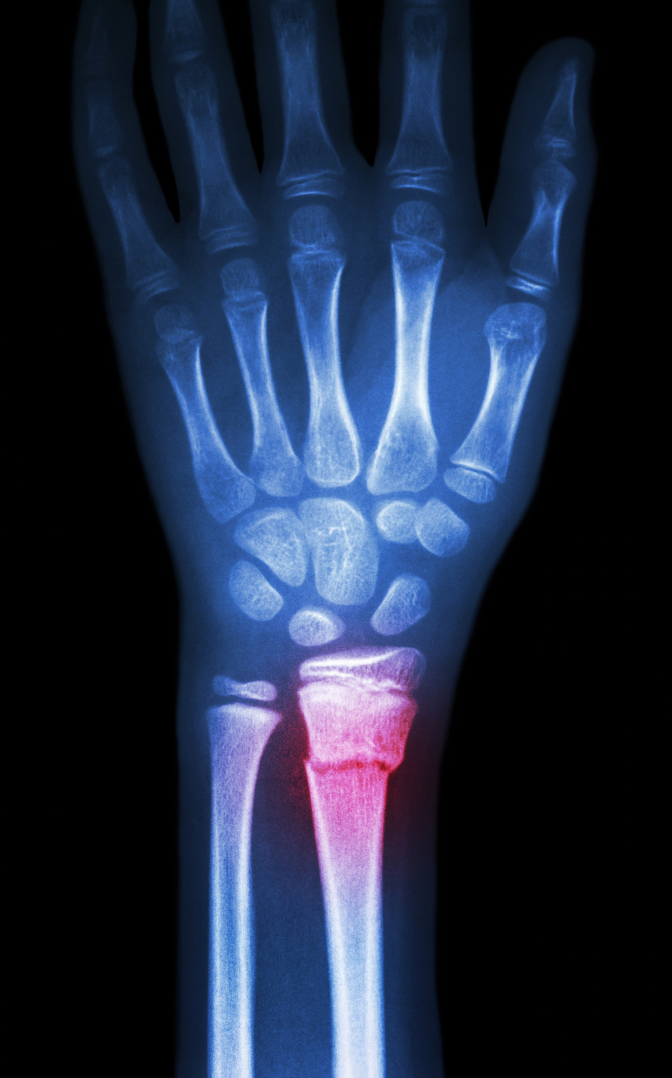 Can You Always See a Fracture in an X-Ray?