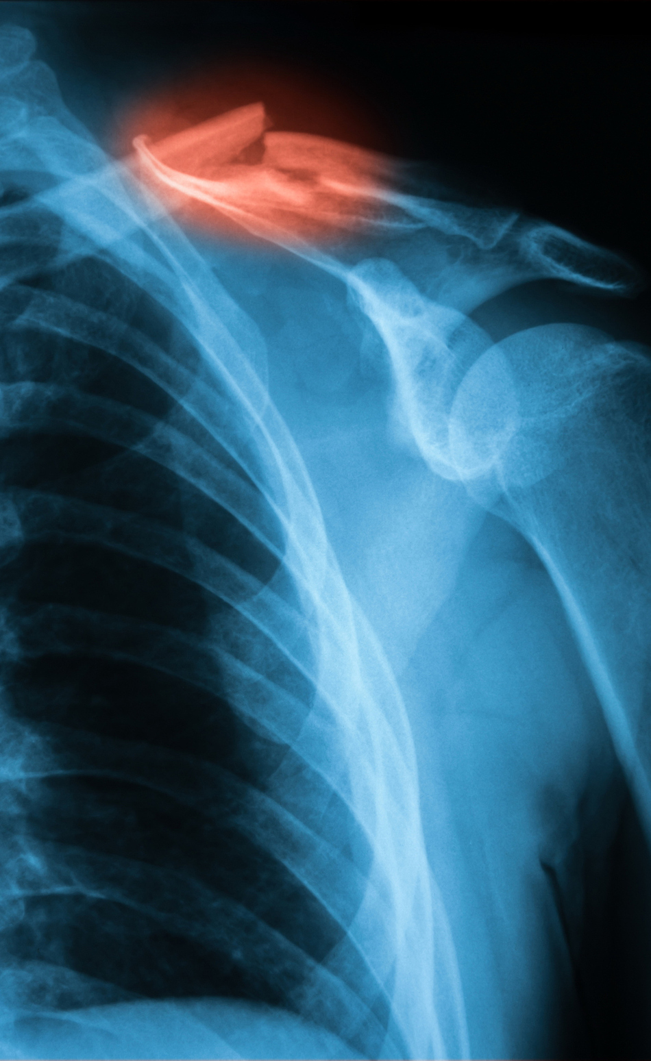 Let a Broken Collarbone Heal Naturally, or Not?