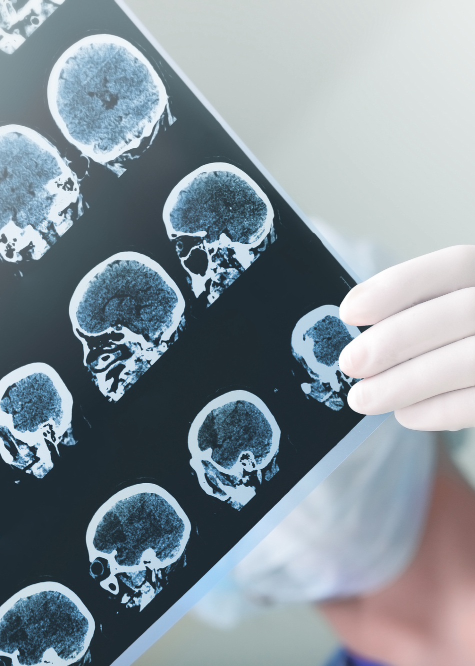 When Should a Meningioma Be Removed?