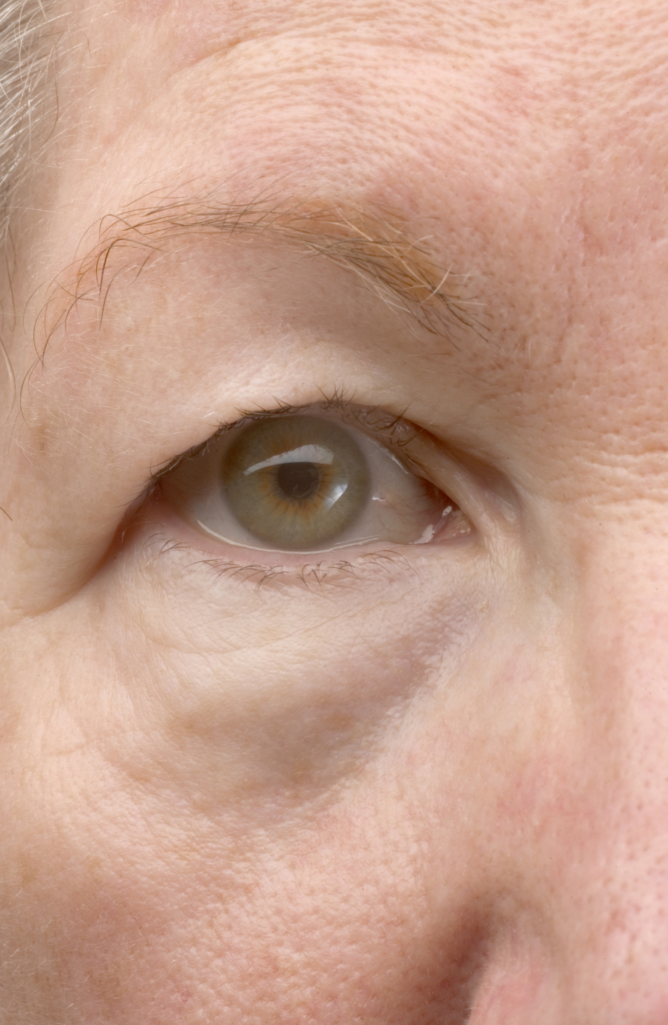 How to Fix Droopy Eyelids?