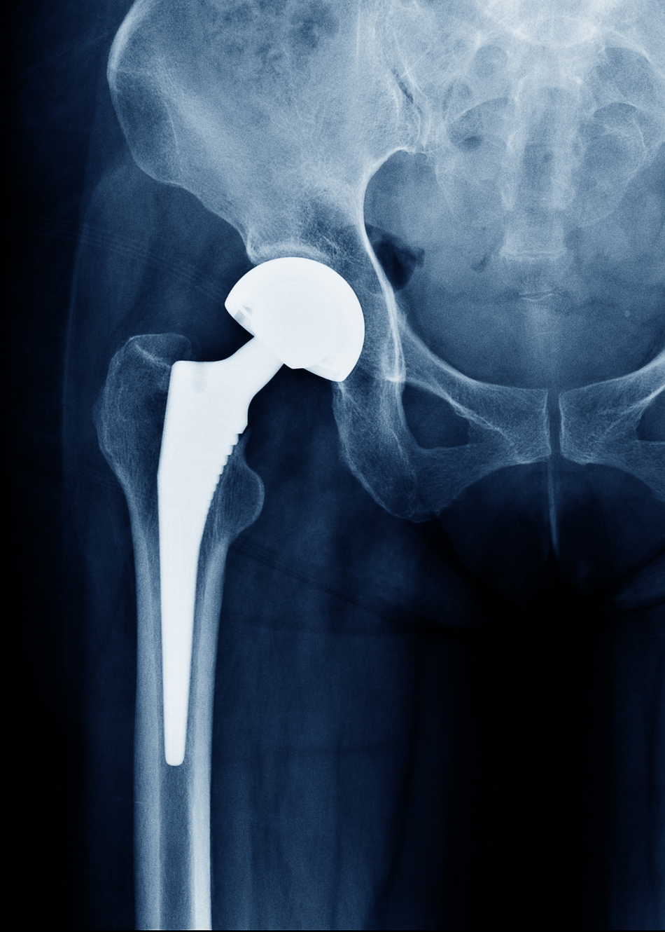 How to Take Care of Your Joint Replacement
