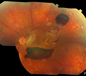 diabetic-retinopathy