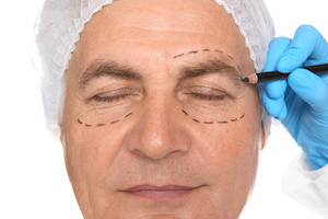 Eyelid Surgery