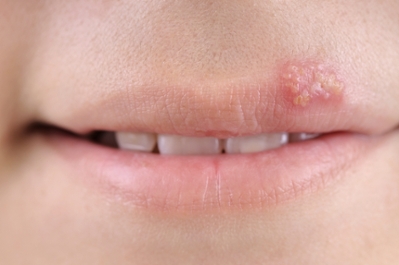 Lips with blister