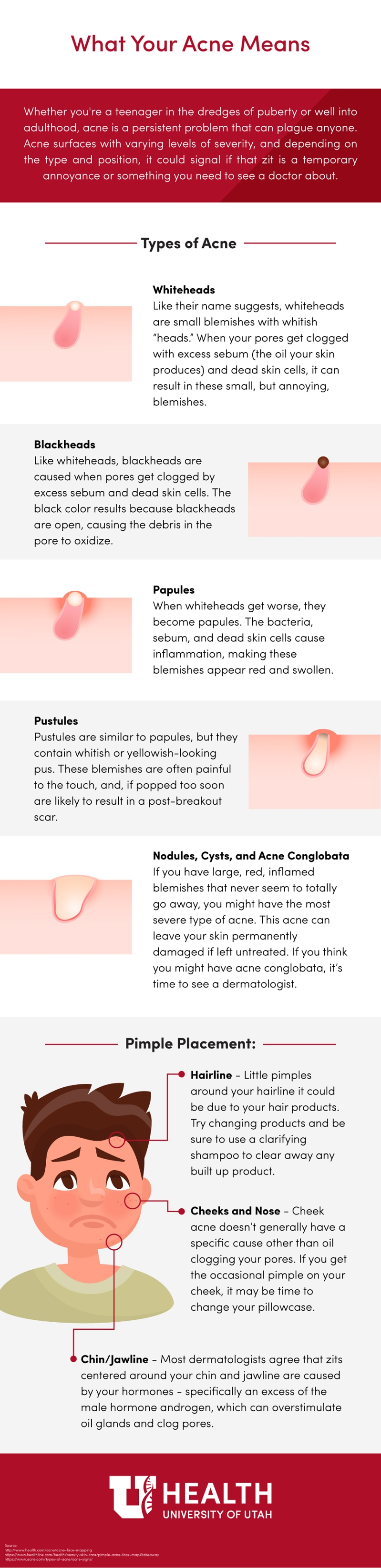 acne infographic
