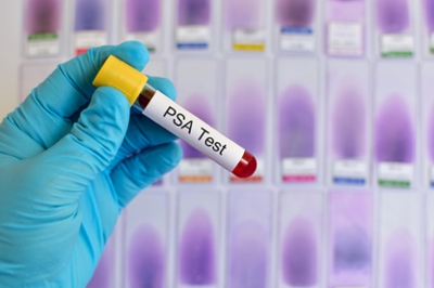 Prostate Cancer Test PSA