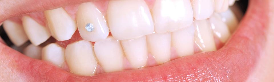Joyas dentales: ¿Son seguras para los dientes?