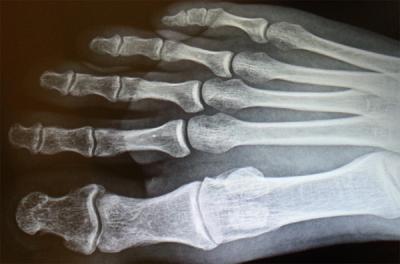Osteoarthritis in the dorsal bones of the foot