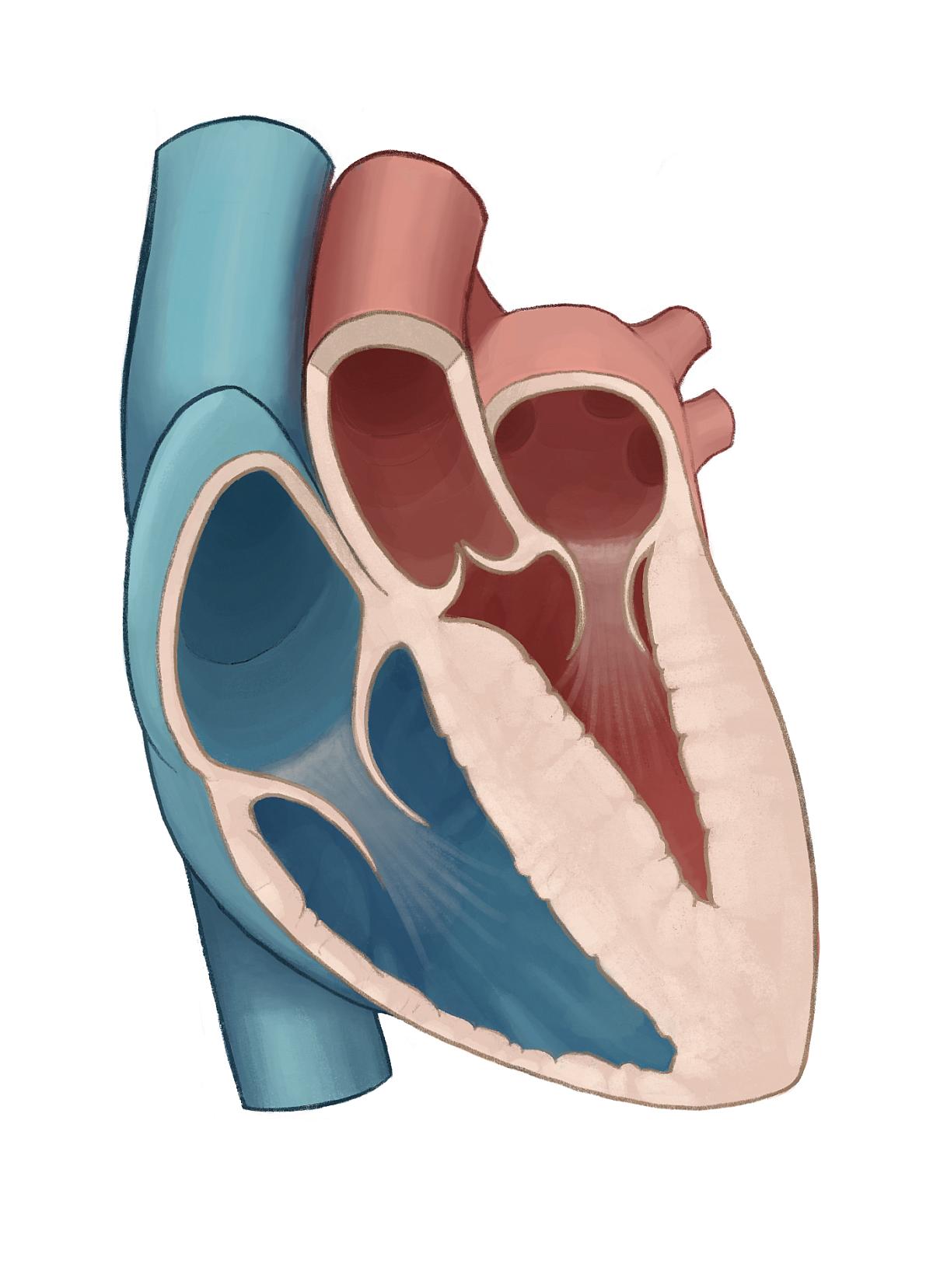 Diffuse hypertrophic cardiomyopathy